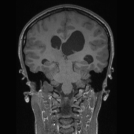 Central neurocytoma (Radiopaedia 37664-39557 Coronal T1 38).png