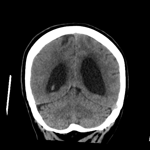 Central neurocytoma (Radiopaedia 65317-74346 Coronal non-contrast 43).png