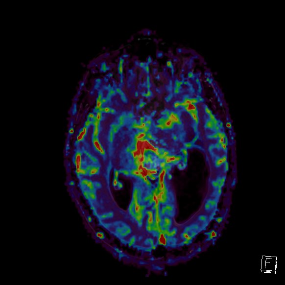 Central neurocytoma (Radiopaedia 84497-99872 Axial Perfusion 176).jpg
