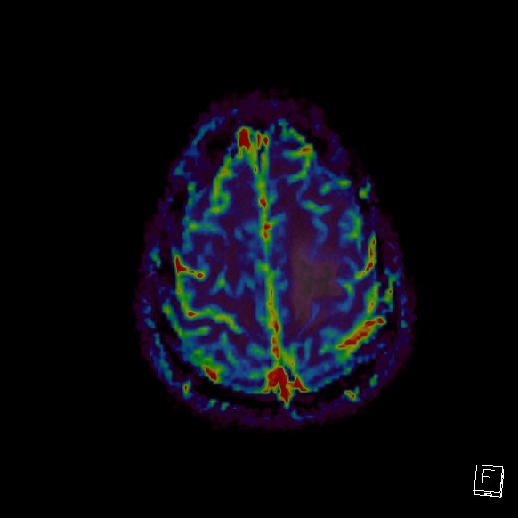 Central neurocytoma (Radiopaedia 84497-99872 Axial Perfusion 48).jpg