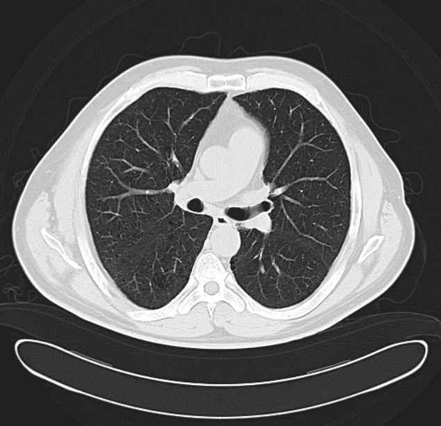 Centrilobular pulmonary emphysema (Radiopaedia 26808-26971 C 21).jpg