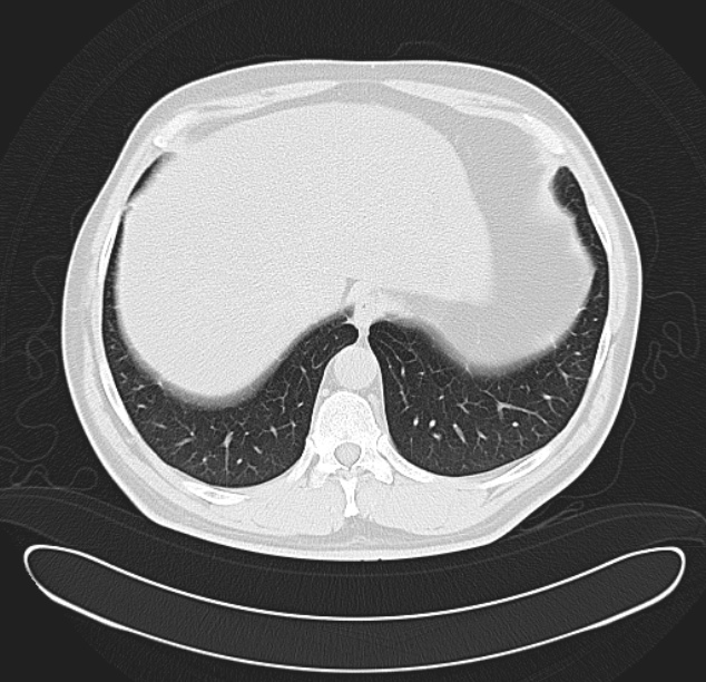 Centrilobular pulmonary emphysema (Radiopaedia 26808-26971 C 38).jpg