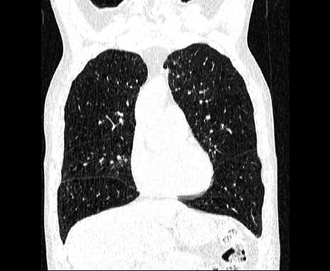 Centrilobular pulmonary emphysema (Radiopaedia 62468-70718 Coronal lung window 25).jpg
