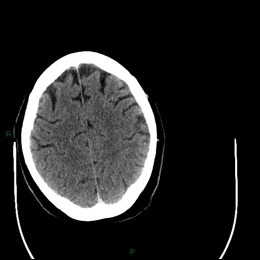 Cerebellar abscess (Radiopaedia 78135-90671 Axial C+ delayed 82).jpg