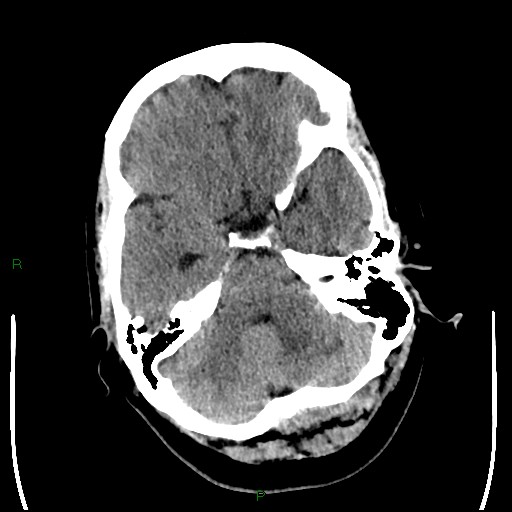 Cerebellar abscess (Radiopaedia 78135-90671 Axial non-contrast 31).jpg