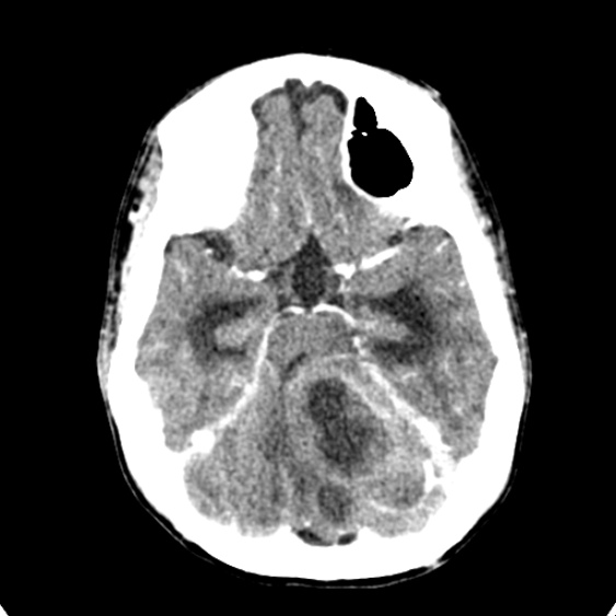 Cerebellar abscess secondary to mastoiditis (Radiopaedia 26284-26412 Axial C+ delayed 52).jpg