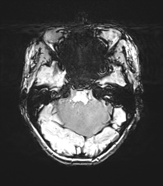 Cerebellar agenesis with hypoplastic pons (pontocerebellar hypoplasia) (Radiopaedia 57224-64138 Axial SWI 27).png