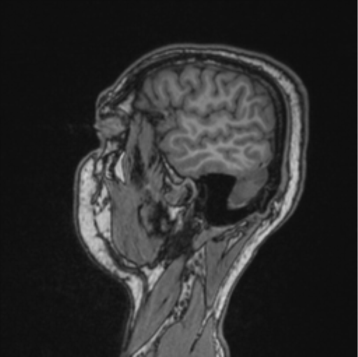 Cerebellar hemangioblastomas and pituitary adenoma (Radiopaedia 85490-101176 Sagittal T1 77).png