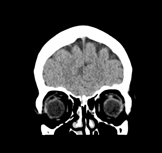 Cerebellar metastasis (Radiopaedia 54578-60812 Coronal non-contrast 9).png