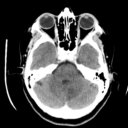 Cerebellar metastasis (cystic appearance) (Radiopaedia 41395-44258 B 15).png