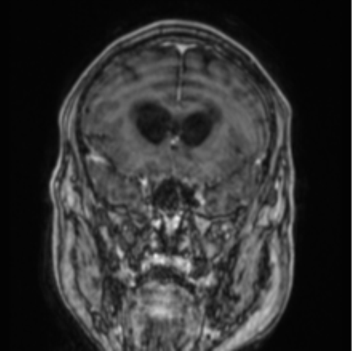 Cerebellar metastasis from lung adenocarcinoma (Radiopaedia 86690-102829 Coronal T1 C+ 68).png