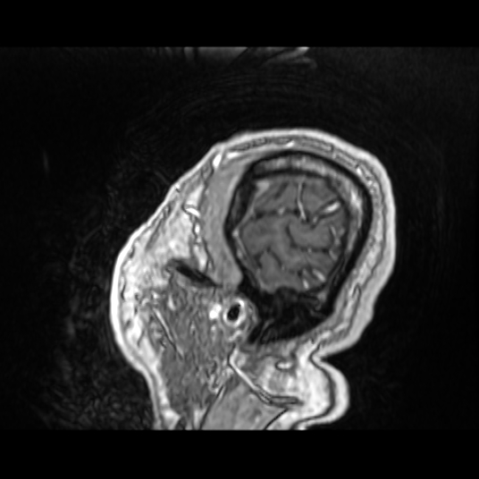 Cerebellar metastasis of pulmonary adenocarcinoma, cavernous venous malformation, and developmental venous anomaly (Radiopaedia 85827-101661 Sagittal T1 C+ 83).jpg