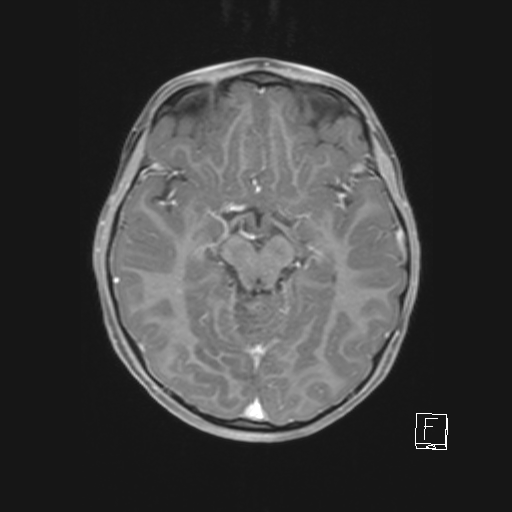Cerebellar stroke (Radiopaedia 32202-33150 Axial T1 C+ 35).png