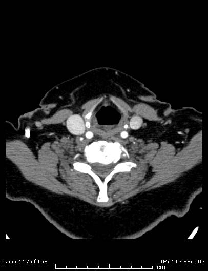 File:Cerebellar strokes due to intracranial giant cell arteritis (Radiopaedia 68799-78510 CT angiogram 117).jpg