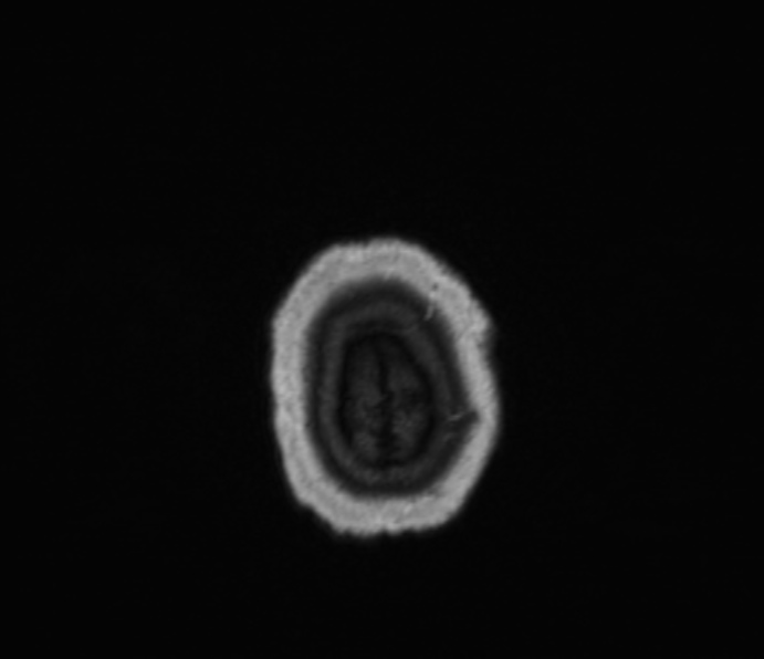 Cerebellopontine angle meningioma (Radiopaedia 35181-36715 Axial T1 C+ 3).jpg