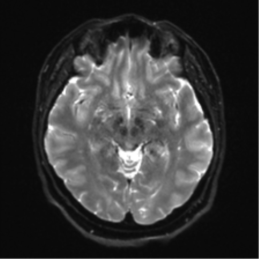 Cerebellopontine angle meningioma (Radiopaedia 48434-53348 Axial DWI 17).png