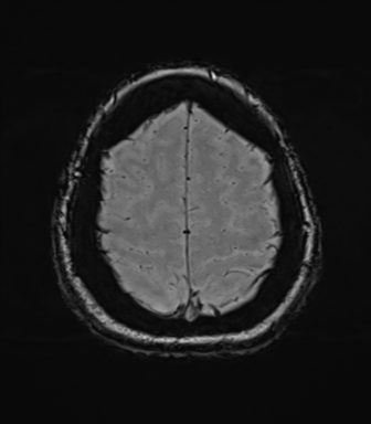 Cerebellopontine angle meningioma (Radiopaedia 48434-53348 Axial SWI 78).png