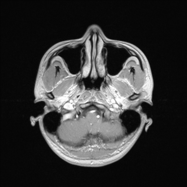 Cerebral abscess (Radiopaedia 24212-24478 Axial T1 C+ 13).jpg