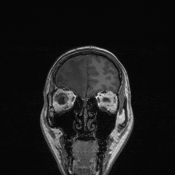 Cerebral abscess (Radiopaedia 24212-24478 Coronal T1 50).jpg