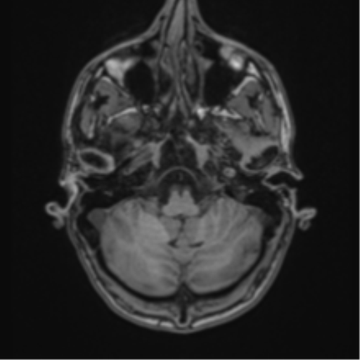 File:Cerebral abscess (Radiopaedia 60342-68009 Axial T1 6).png