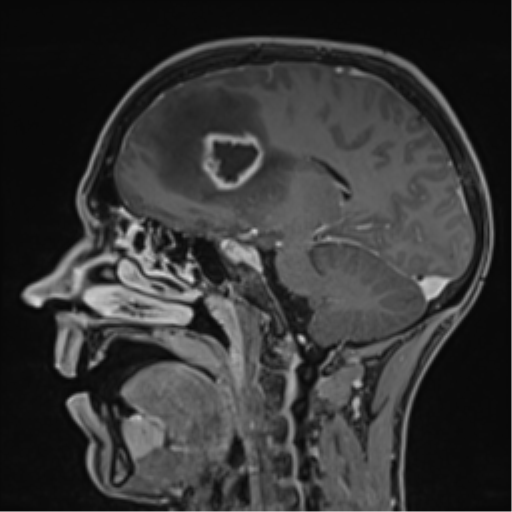 Cerebral abscess (Radiopaedia 60342-68009 J 33).png
