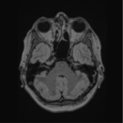 Cerebral abscess from pulmonary arteriovenous malformation (Radiopaedia 86275-102291 J 22).png