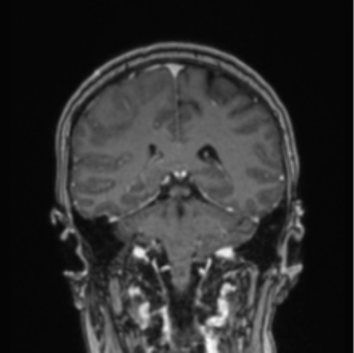 Cerebral abscess from pulmonary arteriovenous malformation (Radiopaedia 86275-102291 L 36).png