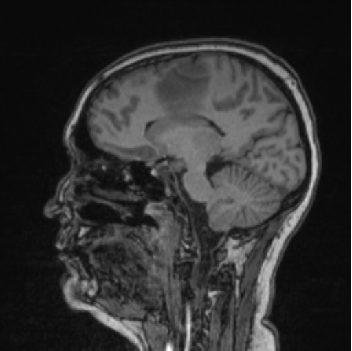 Cerebral abscess from pulmonary arteriovenous malformation (Radiopaedia 86275-102291 Sagittal T1 58).png