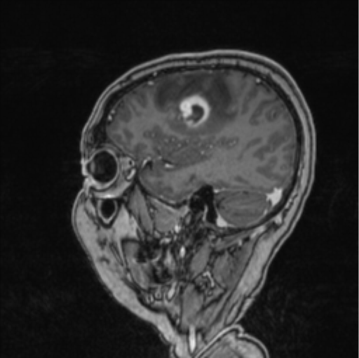 Cerebral abscess from pulmonary arteriovenous malformation (Radiopaedia 86275-102291 Sagittal T1 C+ 58).png