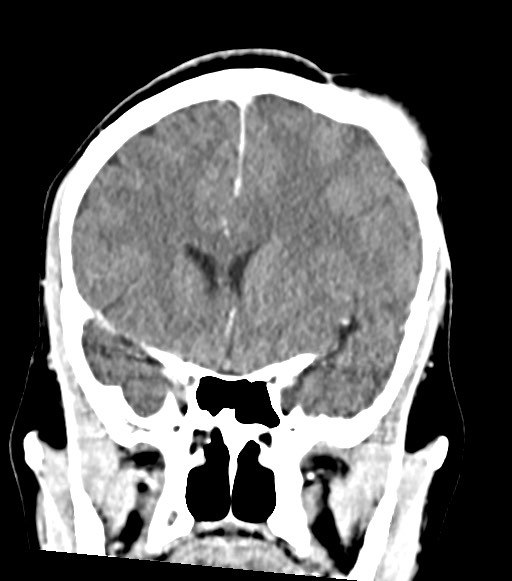 File:Cerebral abscesses (Radiopaedia 70458-80568 Coronal Contrast 25).jpg
