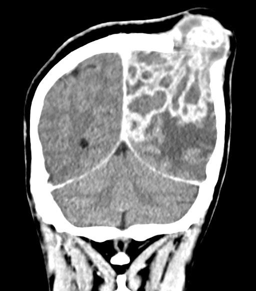 Cerebral abscesses (Radiopaedia 70458-80568 Coronal Contrast 52).jpg