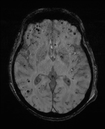 Cerebral amyloid angiopathy-related inflammation (Radiopaedia 74836-85849 Axial SWI 37).jpg