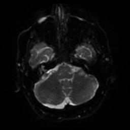 Cerebral amyloid angiopathy (Radiopaedia 28698-28978 Axial DWI 34).jpg