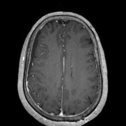 Cerebral amyloid angiopathy (Radiopaedia 29129-29518 Axial T1 C+ 99).jpg