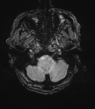 File:Cerebral amyloid angiopathy (Radiopaedia 46082-50433 Axial SWI 9).png