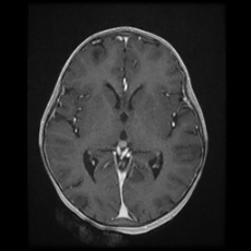 Cerebral and spinal tuberculosis (Radiopaedia 90489-107837 Axial T1 C+ 102).jpg