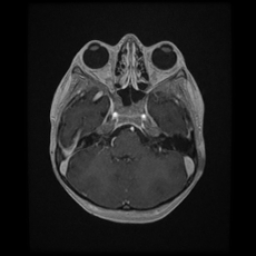 Cerebral and spinal tuberculosis (Radiopaedia 90489-107837 Axial T1 C+ 59).jpg