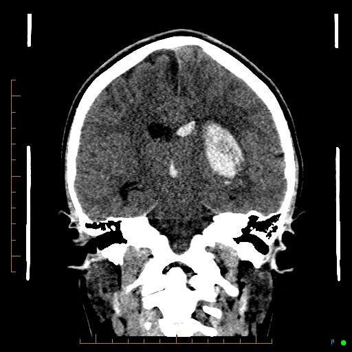 Cerebral arteriovenous malformation (AVM) (Radiopaedia 78162-90706 Coronal non-contrast 55).jpg