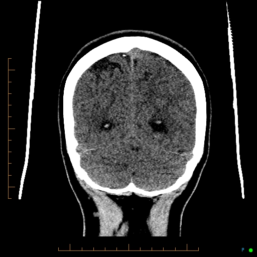 Cerebral arteriovenous malformation (AVM) (Radiopaedia 78162-90706 Coronal non-contrast 79).jpg