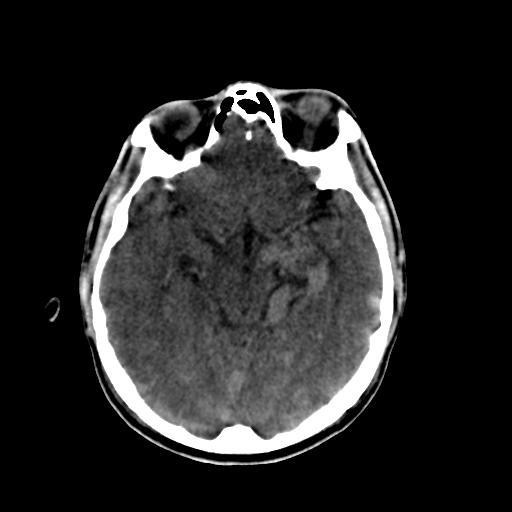 Cerebral arteriovenous malformation (Radiopaedia 28518-28759 Axial non-contrast 29).jpg