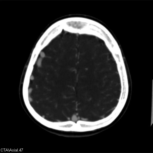 Cerebral arteriovenous malformation (Radiopaedia 28518-28759 B 47).jpg