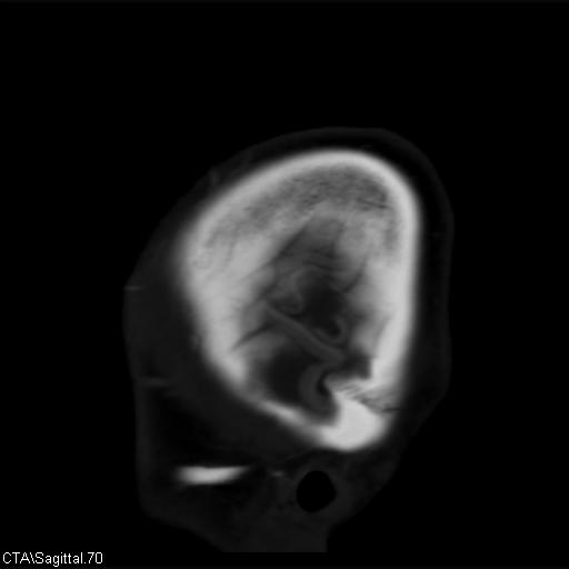 File:Cerebral arteriovenous malformation (Radiopaedia 28518-28759 D 67).jpg