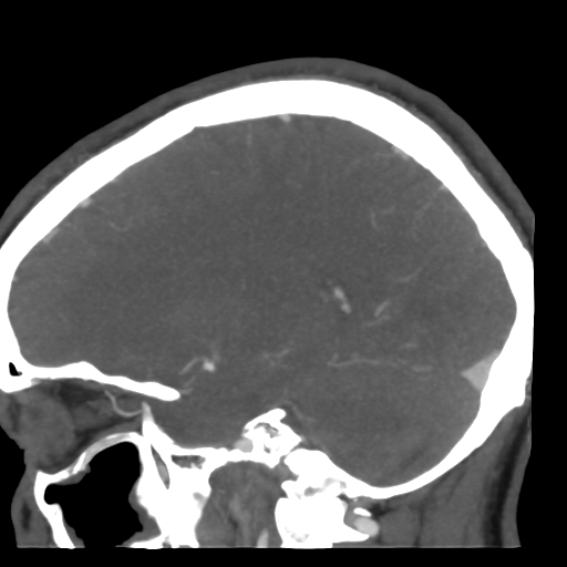 Cerebral arteriovenous malformation (Radiopaedia 39259-41505 Sagittal 40).png