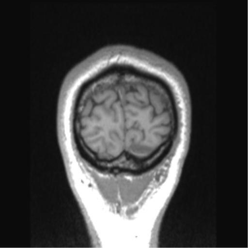 Cerebral arteriovenous malformation (Radiopaedia 39259-41506 Coronal T1 9).png
