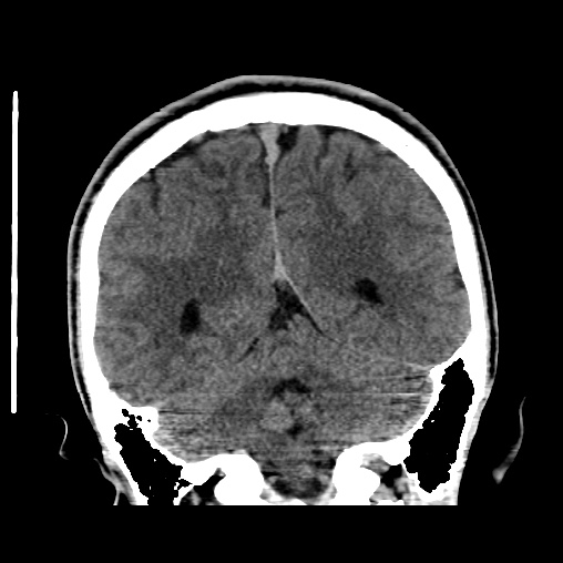 Cerebral arteriovenous malformation (Radiopaedia 61964-70028 Coronal non-contrast 43).jpg
