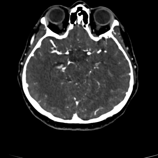 Cerebral arteriovenous malformation (Radiopaedia 73830-84645 Axial C+ delayed 56).jpg