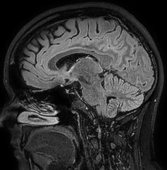 Cerebral arteriovenous malformation (Radiopaedia 74411-85654 Sagittal FLAIR 55).jpg