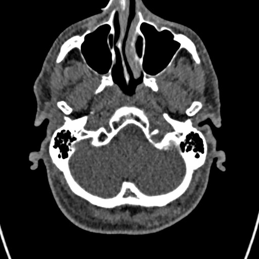 Cerebral arteriovenous malformation (Radiopaedia 78188-90746 Axial non-contrast 25).jpg