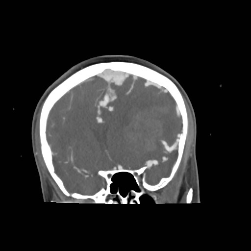 File:Cerebral arteriovenous malformation (Radiopaedia 79677-92888 B 12).jpg