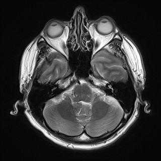 File:Cerebral arteriovenous malformation (Radiopaedia 84015-99245 Axial T2 8).jpg